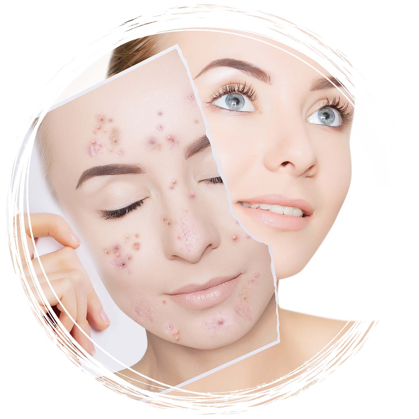 Acne Clinic